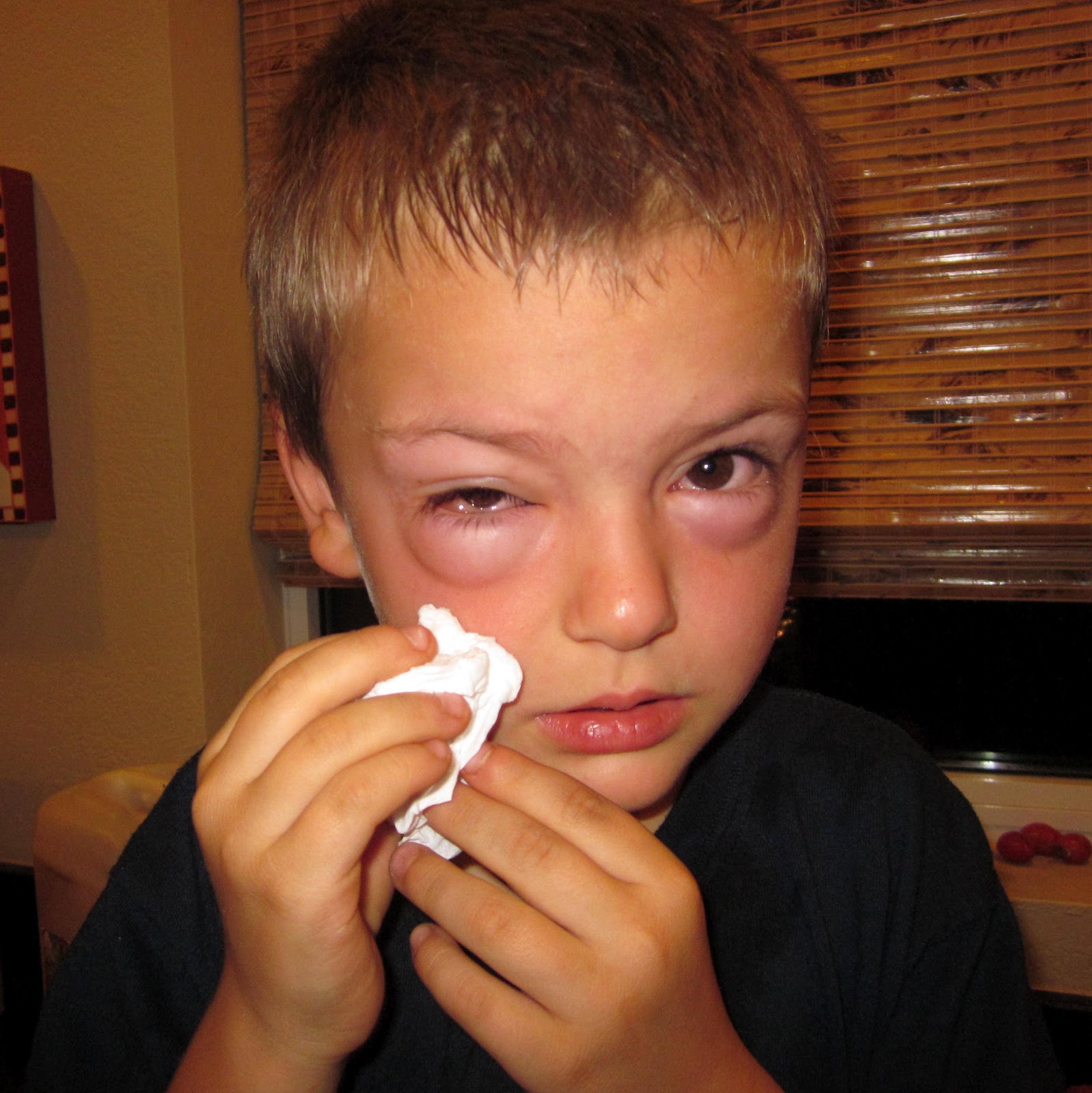 Taste is Trump. A Big, Bad Reaction {Allergies}