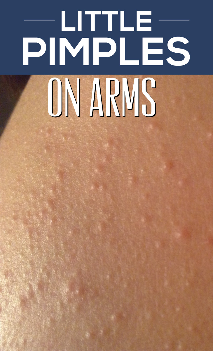 I Have Little Pimples On My Arms - Doctor insights on ...