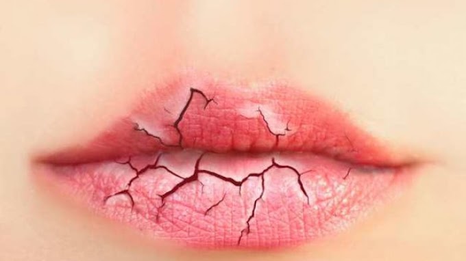 Tips Mengatasi bibir kering 