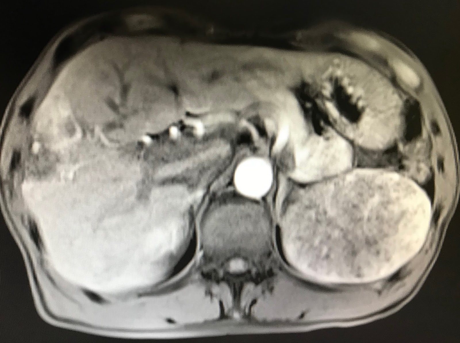 VIETNAMESE MEDIC ULTRASOUND CASE 484 SPLEEN TUMOR, Dr PHAN THANH HẢI