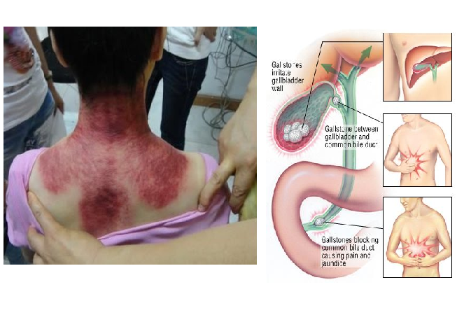 Waspada Inilah Ciri Ciri Masuk Angin Pembawa Maut Angin Duduk Dan Cara Mengatasinya Aneka Resep Kue Dan Masakan Enak Arkme