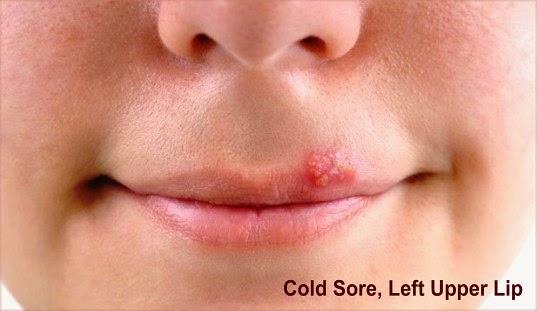 Cold Sore On Left Upper Lip