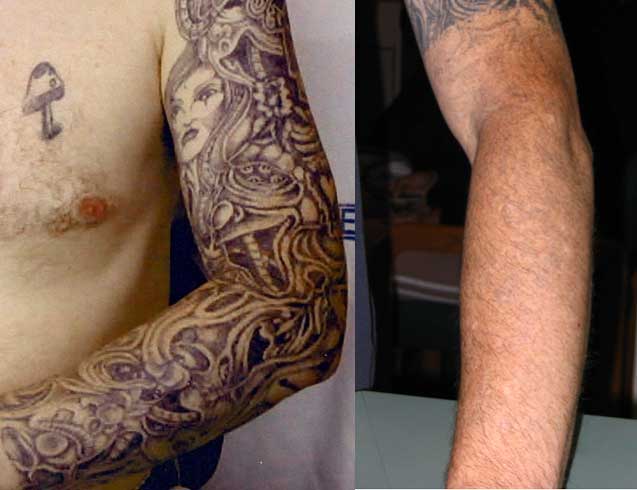 Tattoo Removal Before And After Video Half Sleeve Tattoo ...