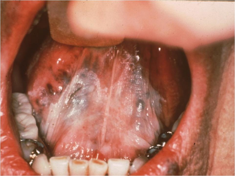 Dentistry lectures for MFDS/MJDF/NBDE/ORE: Facts on ... diagram of squamous cell carcinoma 