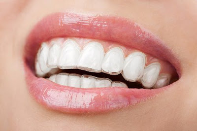 Niềng răng không mắc cài là gì? Một số ưu điểm nổi trội-1