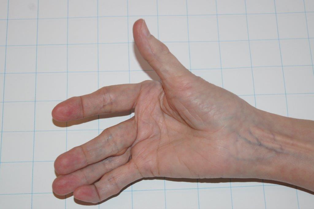 Here's Your Gold Watch Rheutired Arthroplasty of the MCP Joints (New