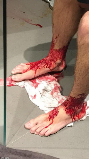 This teen dips his feet into the water but ends up getting a bloodied feet after the flesh-eating bugs fed on his feet! 