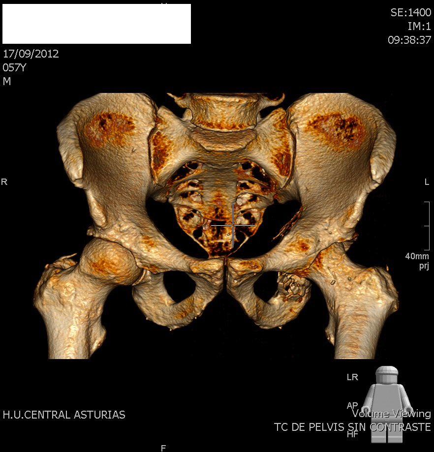 Salud Osteoarticular: FRACTURA PATOLÓGICA ACETABULAR: PLASMOCITOMA