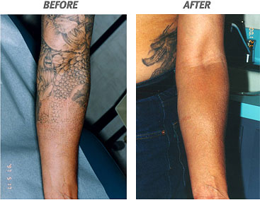 nyccosmeticdermatology: Tattoo Removal Cream Review ...