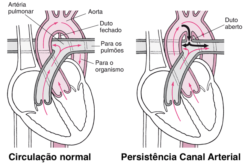 Persistência do canal arterial (PCA) em recémnascidos prematuros / O Pai, a Mãe e Eu! Persistência do canal arterial (PCA) em recémnascidos prematuros / O Pai, a Mãe e Eu!