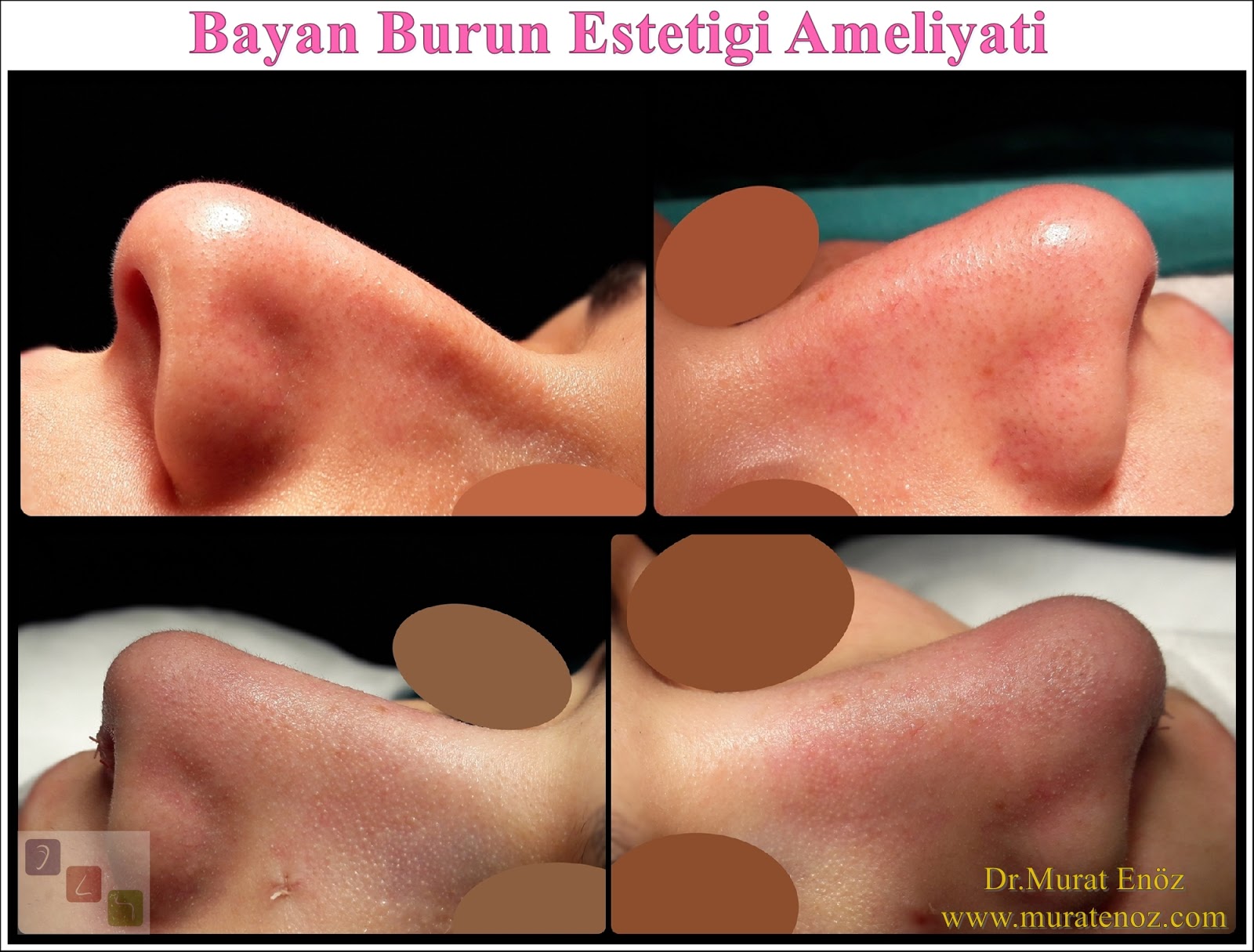 Bayan Burun Estetiği Ameliyatı