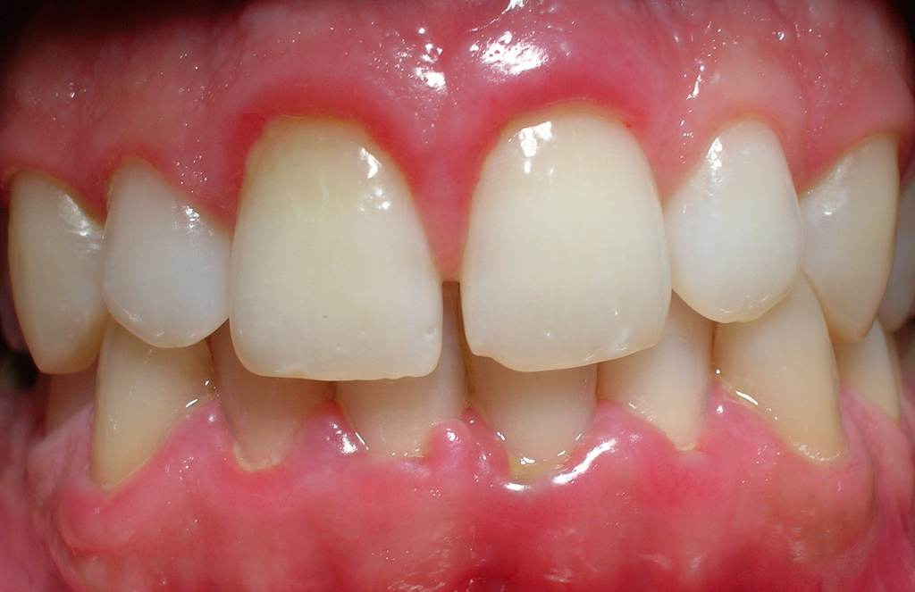GINGIVITIS POR PLACA