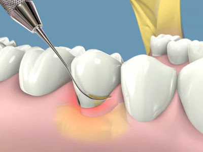 Cạo vôi răng siêu âm - Giải pháp cho sức khỏe răng miệng tốt nhất-2