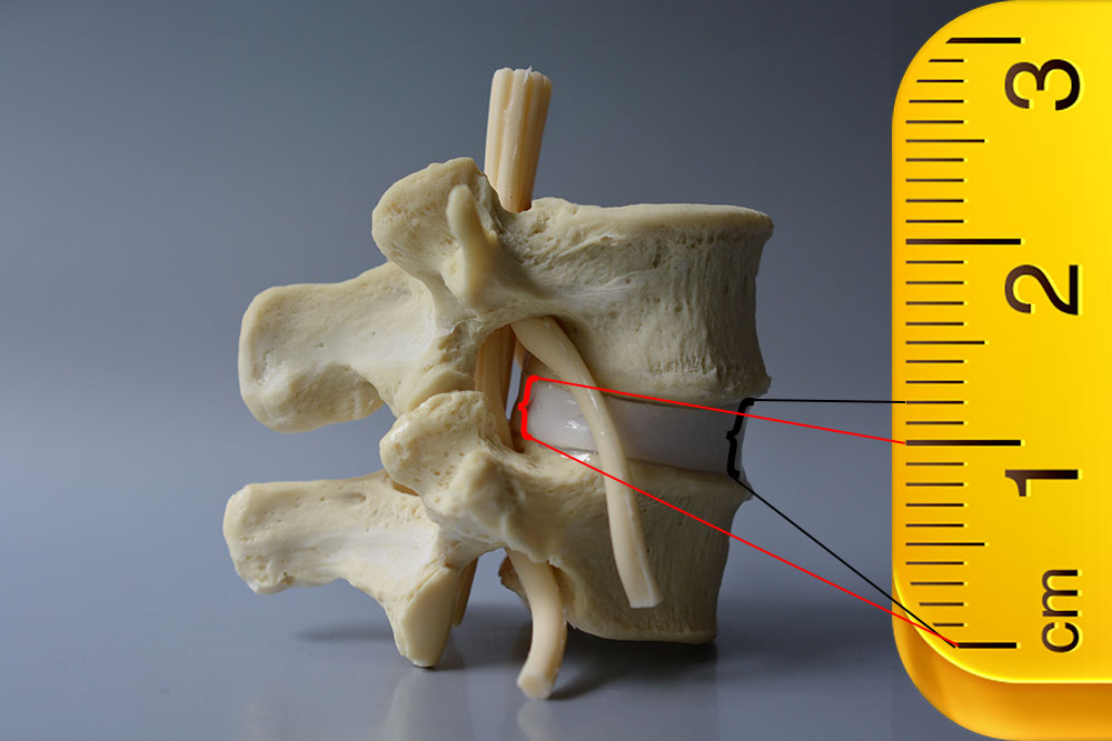 Understanding Disc Height Loss Dynamic Disc Designs Anatomical Spine