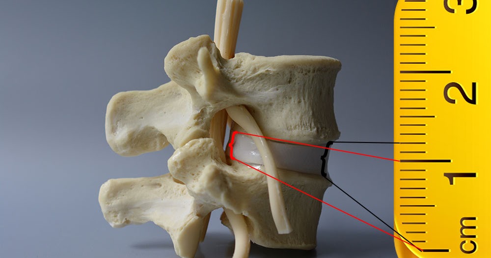 Understanding Disc Height Loss Dynamic Disc Designs Anatomical Spine