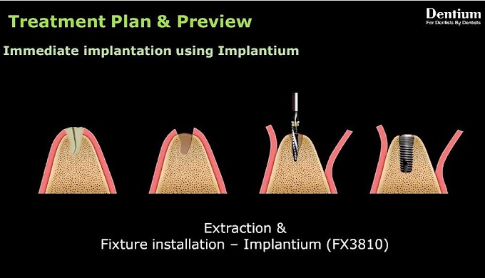 IMPLANTOLOGY: Immediate implantation with GBR on posterior mandibular area - Dr. Park Won bae