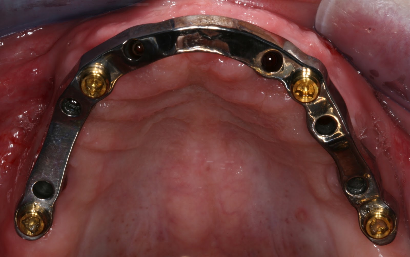 Dr. Workman, DDS Implant Supported Dentures Broomfield