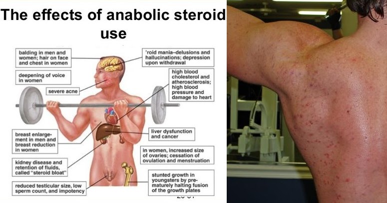 the definition and effects of steroids and their usage Definition of steroid in the audioenglishorg dictionary meaning of steroid what does steroid mean proper usage and pronunciation (in phonetic transcription) of the word steroid. the definition and effects of steroids and their usage Definition of steroid in the audioenglishorg dictionary meaning of steroid what does steroid mean proper usage and pronunciation (in phonetic transcription) of the word steroid.
