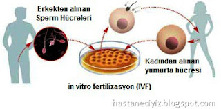 tüp bebek yöntemi, ivf, in vitro fertilizasyon