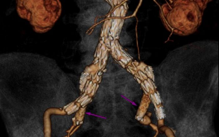 атеросклероз окклюзия подвздошных артерии. аневризма подвздошной артерии графт. аневризма аорты подвздошной артерии. инфраренальная аневризма аорты. аневризма брюшной аорты операция.