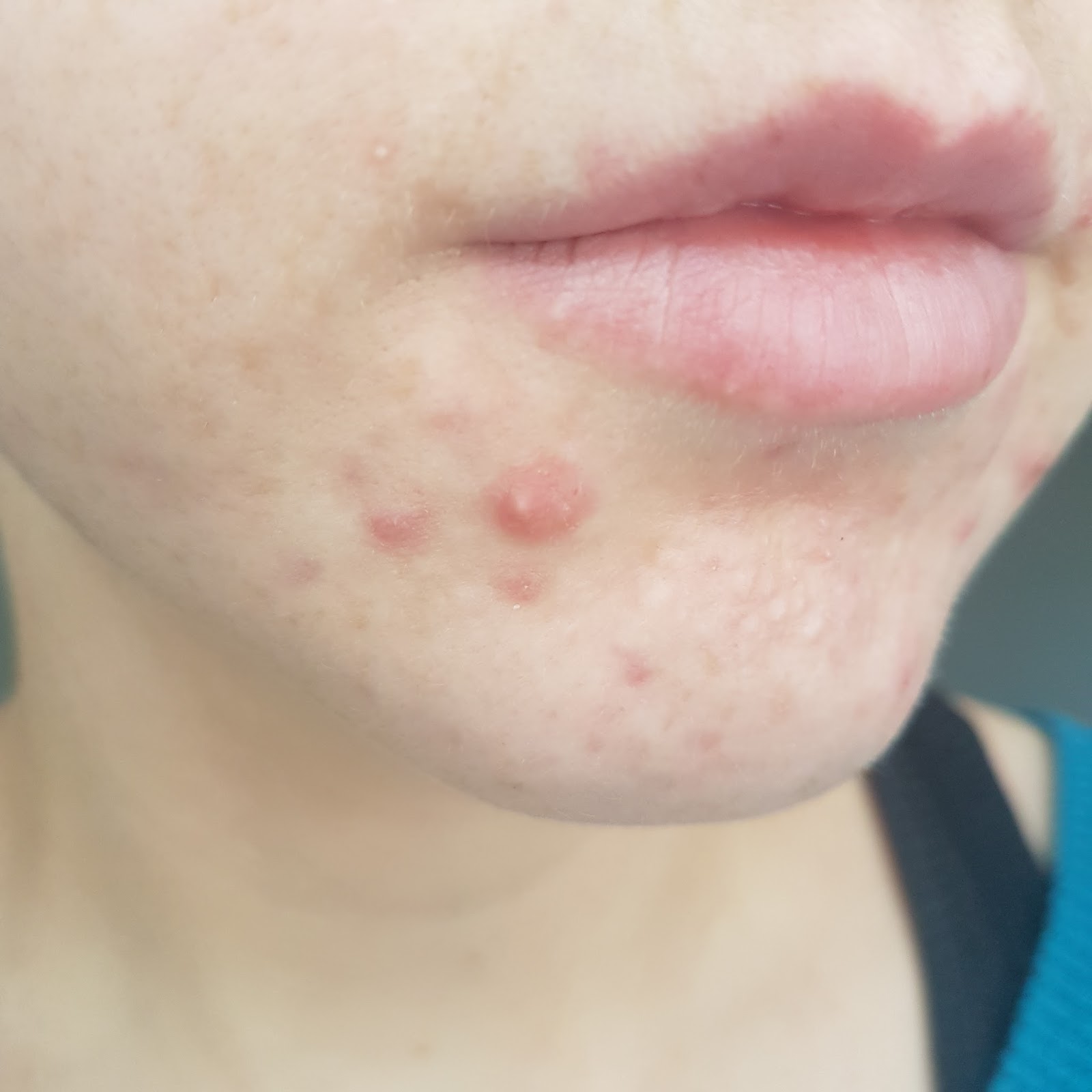 Acne Before Image
