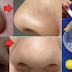 Ways To Remove Tons Of Blackheads and Whiteheads Using Lemon and Salt
