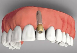 Giá trồng răng số 6 Gia-cam-ghep-implant-hien-nay-2