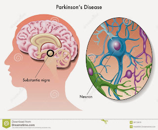 Penyakit  Parkinson merupakan bentuk kelainan neurologis progresif yang menyerang pusat otak yang bertanggung jawab terhadap kontrol dan regulasi gerakan. Terjadi penipisan dopamin dalam substansia nigra dan korpus striatum karena proses degenerasi.