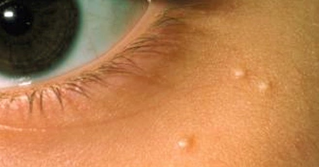 Idea necessary blood filled pimples on my dick valuable Sorry, that blood filled pimples on my dick confirm. And