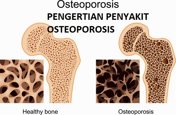 Pengertian Penyakit Osteoporosis Gejala, Penyebab dan Pencegahan