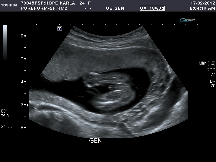 The Hope Family Ultrasound 18 weeks &amp; 3 days