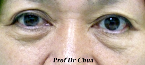 Eyelid Surgery by Prof Dr CN CHUA 蔡鐘能: What Are the Causes of Eyebags?