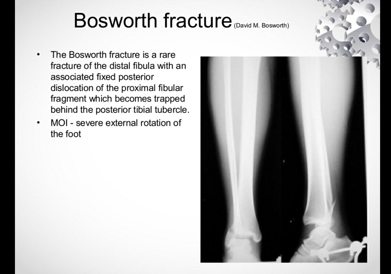 Bosworth fracture