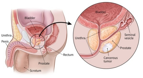 prostate adenocarcinoma icd 10