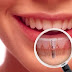 Phục hình răng đã mất với trồng răng implant