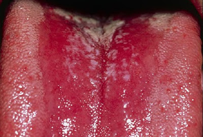 Những vấn đề bệnh nghiêm trọng về miệng Benh-nam-Thrush