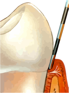 gingivitis home treatment or home remedies for gingivitis