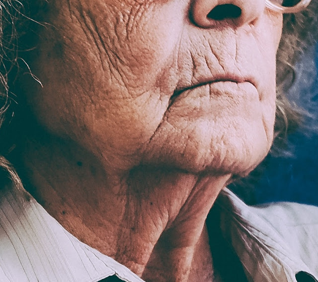 Surcos, arrugas y descolgamiento La imagen muestra dos características del envejecimiento severo: la aparición de surcos muy profundos y el descolgamiento generalizado de la cara y el cuello.