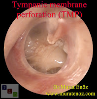 Tympanic Membran Perforation - A Hole In The EardrumTympanoplasty Operation - Tympanoplasty Animation - Repair of Tympanic Membran Perforation - Transcanal (Transmeatal, Endomeatal) Tympanoplasty - A Hole In The Eardrum - Myringoplasty Technique - Tympanoplasty Indications - Tympanoplasty Contraindications - Postoperative Patient Care For Tympanoplasty Operation - Post-operative Instructions for Tympanoplasty