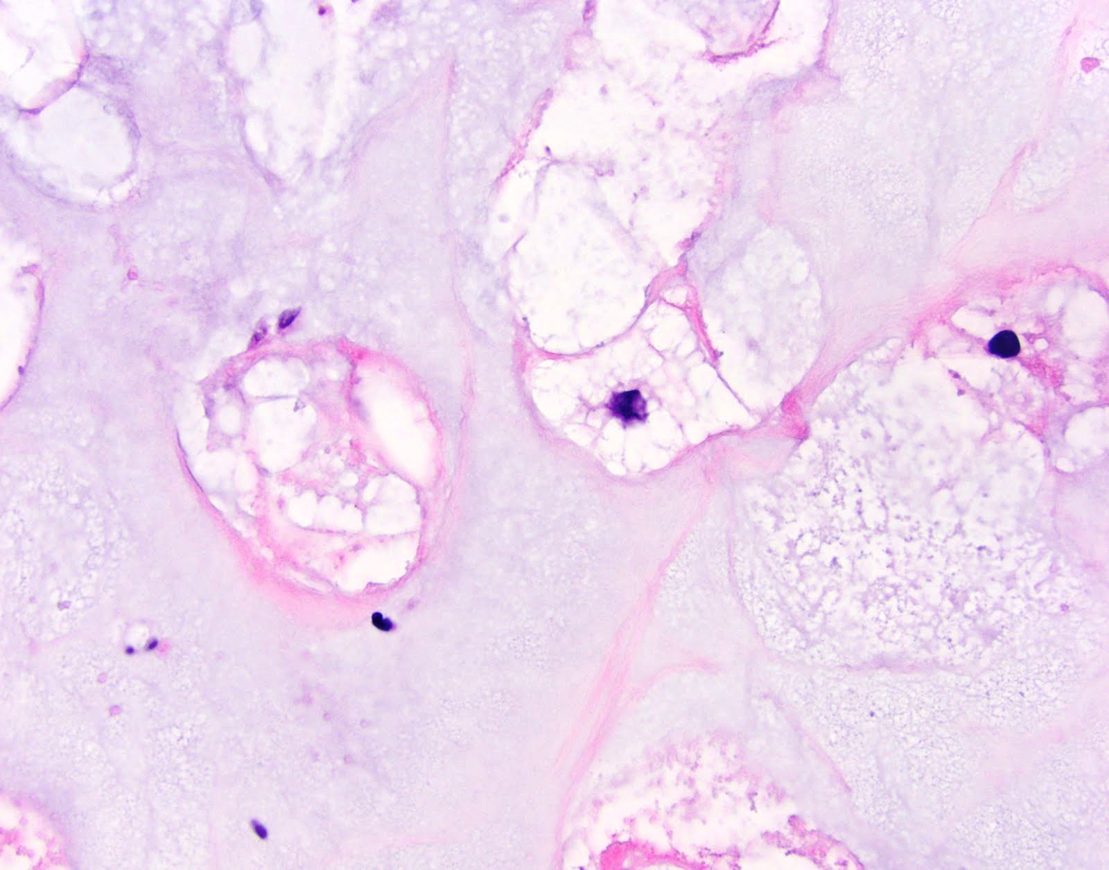 neuropathology blog: Etymology of the word "physaliferous"