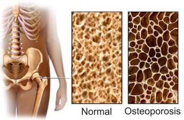 Cara Mencegah Osteoporosis pria wanita