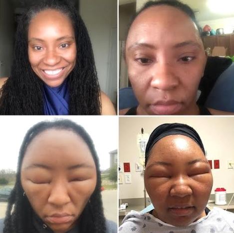 gistmeafrica: Woman shares photos of horrific allergic reaction to hair ...
