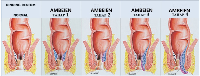  Wasir, ambeien, atau hemorrhoid adalah pembuluh darah vena yang membengkak serta meradang di sekitaran anus atau rektum bawah. Wasir bisa keluar didalam rektum atau di sekitaran anus. Umumnya wasir karena sebab seringkali mengejan waktu BAB. Klasifikasi wasir dibagi berdasar pada letaknya.