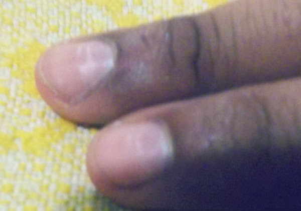 manchas blancas en las uñas