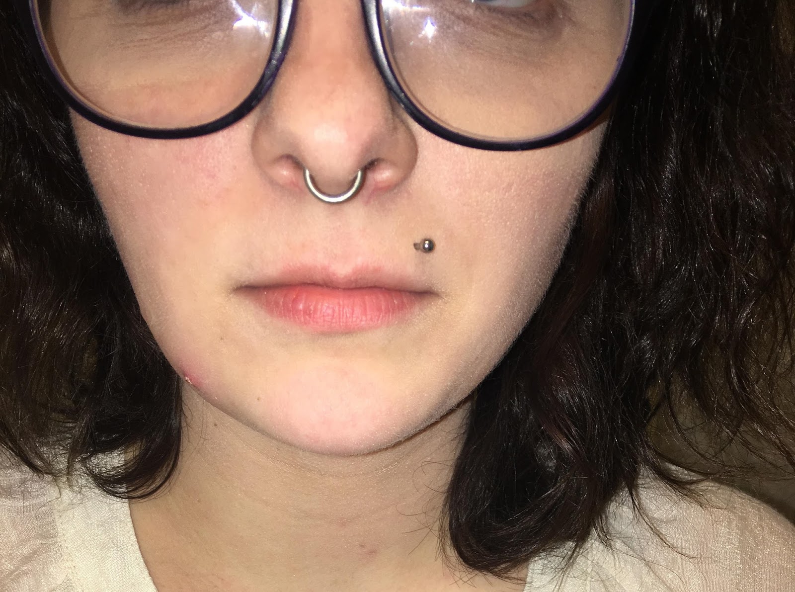 Mr. ZIT CRAZY FACE INFECTION (Staph on face)