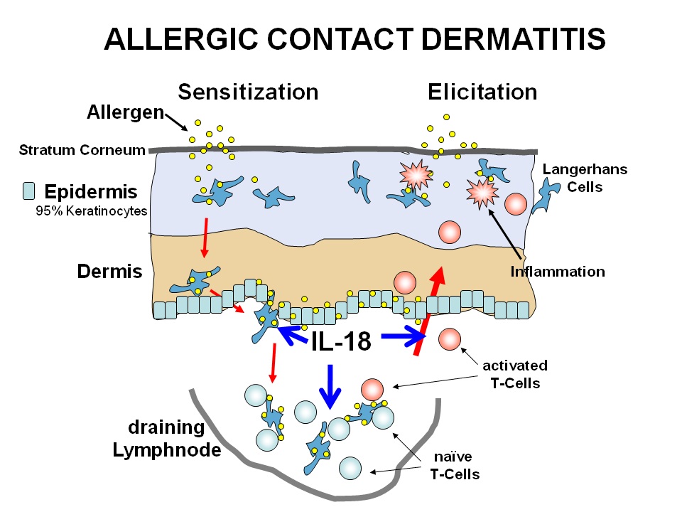 Irritant Contact Dermatitis Skin Rash - Verywell