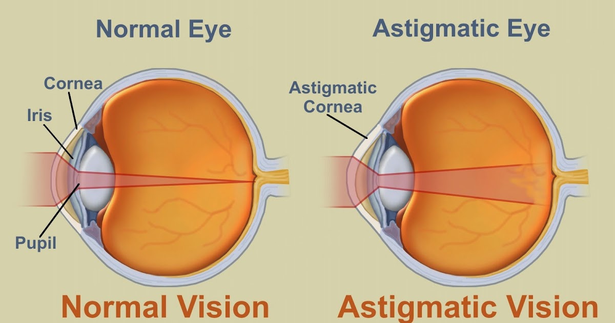 Vision Source New Westminster: What is Astigmatism?