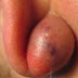 YOU DO NOT HAVE TO DO SURGERY, HERE’S HOW YOU CAN REMOVE ALMOST ALL KINDS OF CYSTS