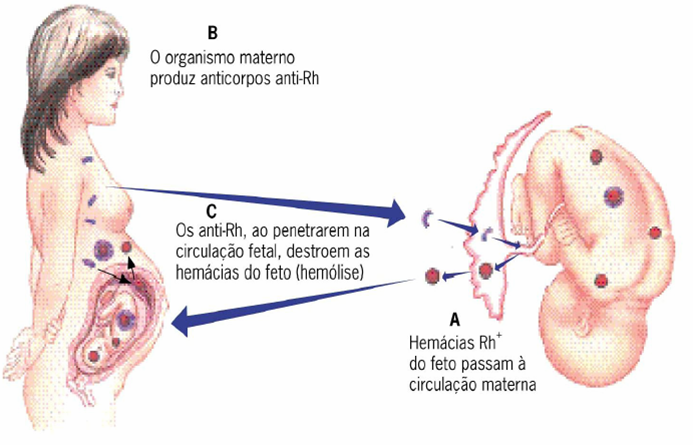 eritroblastose fetal