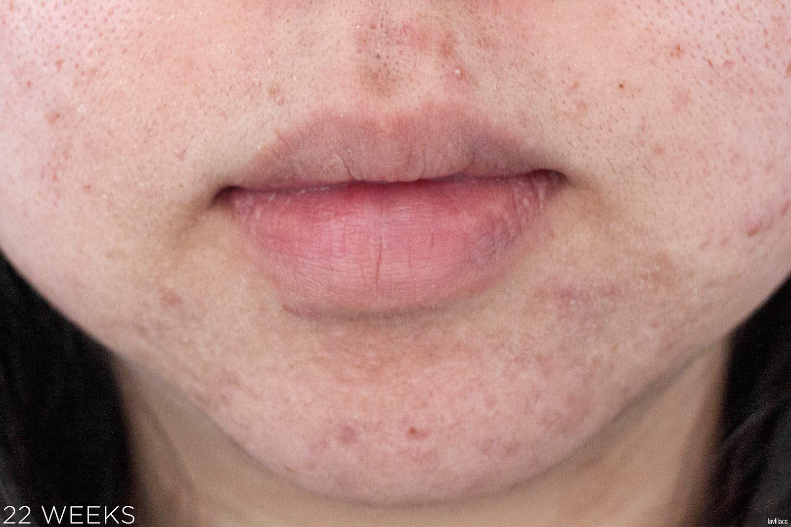 tria Hair Removal Laser Facial Hair 22 Weeks, 5 months Closeup
